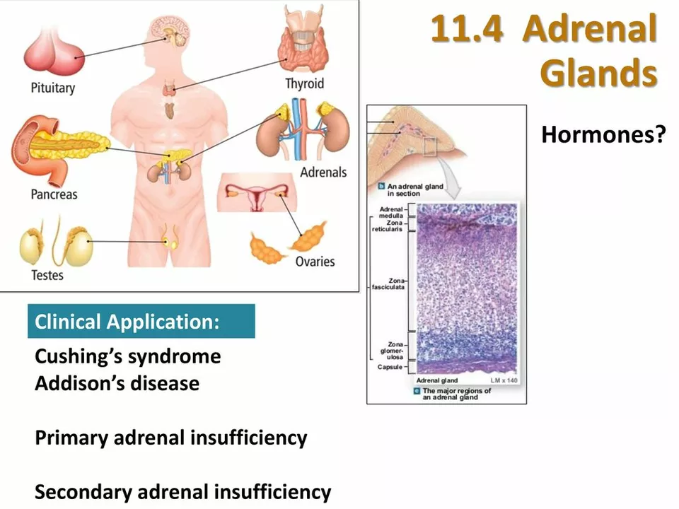 The use of budesonide in treating adrenal insufficiency