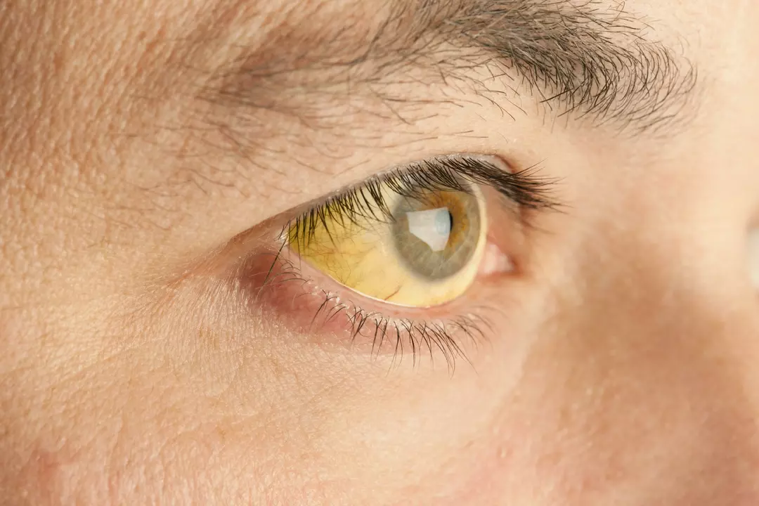 The Connection Between Liver Failure and Eye Health